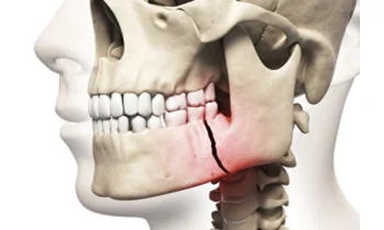 Bone loss