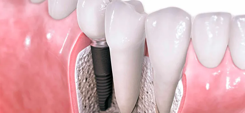 Dental implants at South Dental
