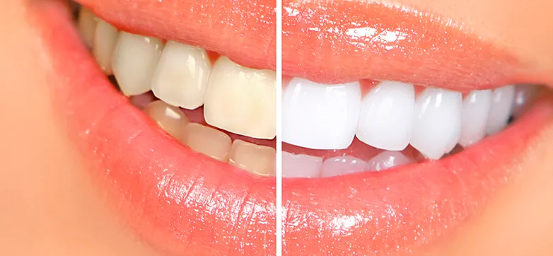 Teeth whitening at South Dental